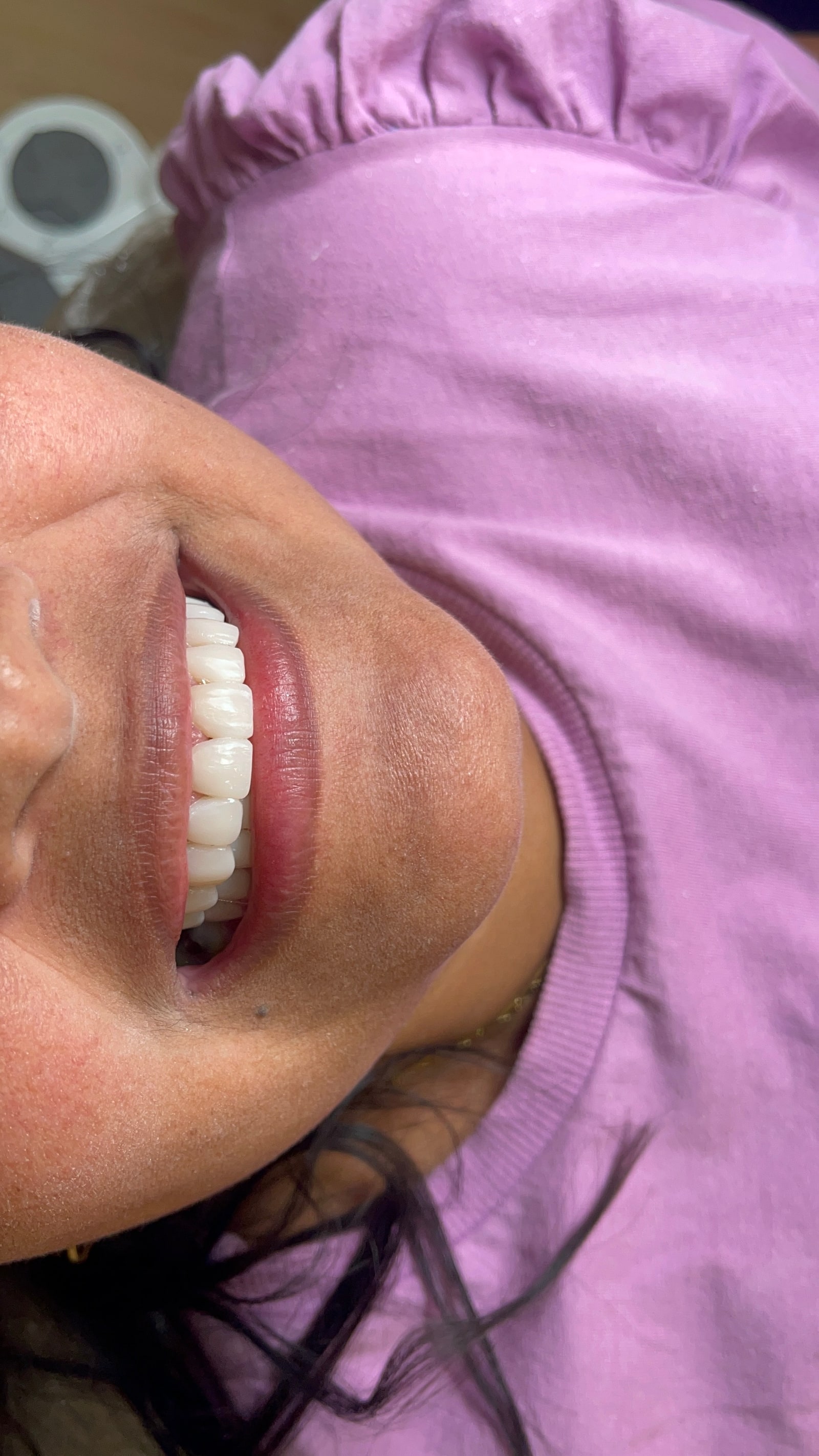 Depois — Facetas em porcelana — ajuste de forma e cor
