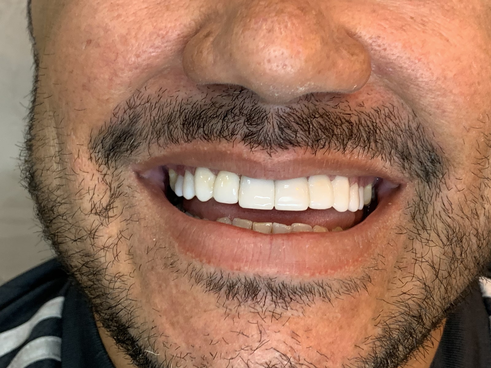 Depois — Facetas em porcelana — transformação do sorriso