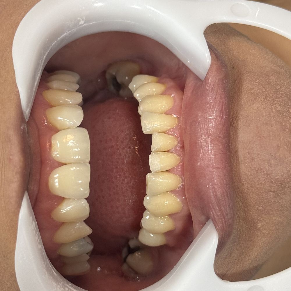 Antes — Facetas em porcelana — reabilitação estética completa