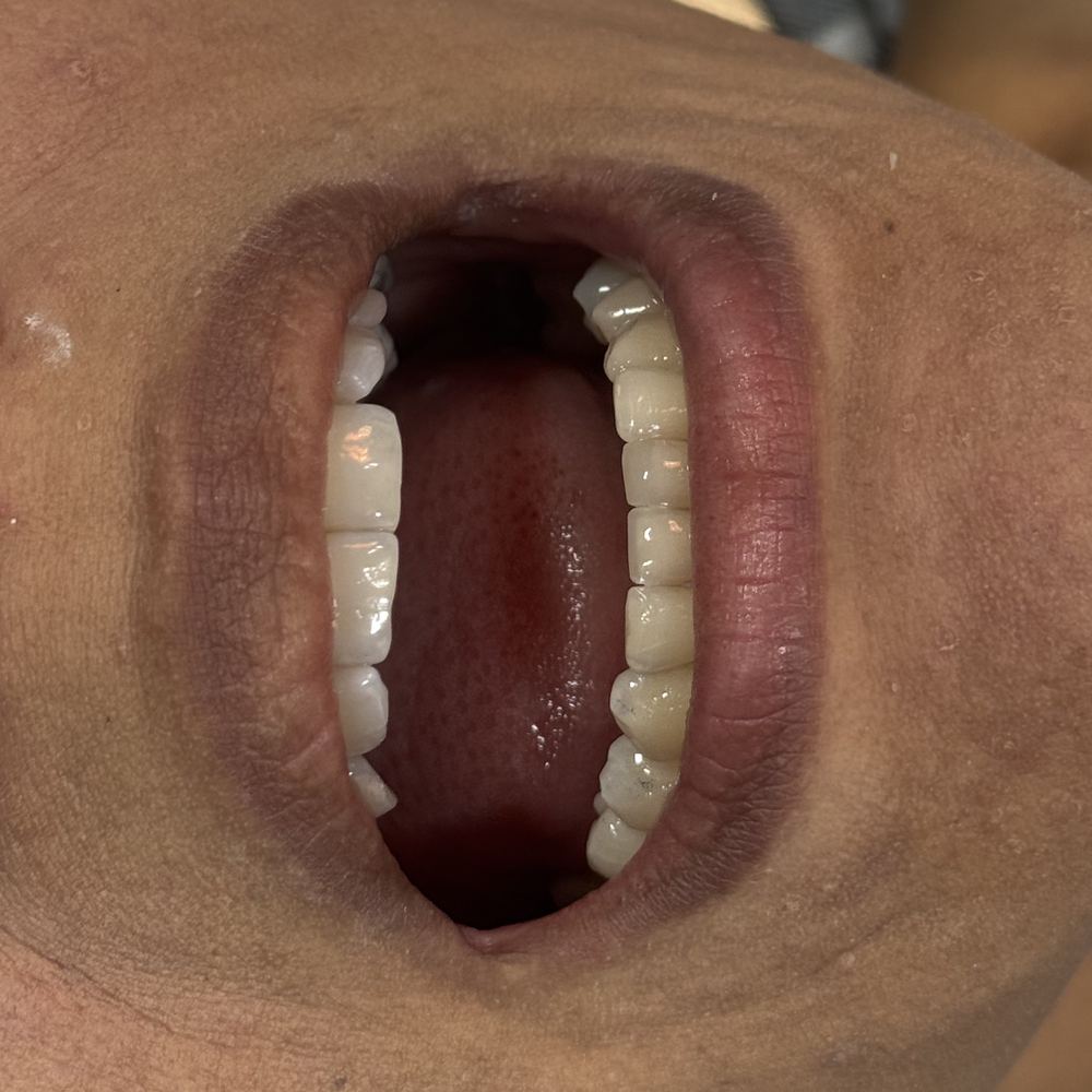 Depois — Facetas em porcelana — reabilitação estética completa