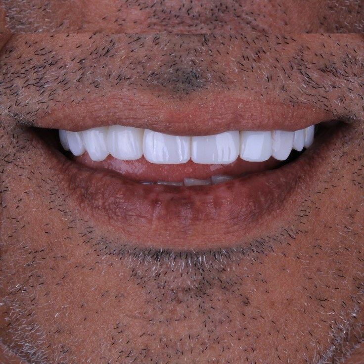 Depois — Facetas em porcelana — recuperação de dente fraturado